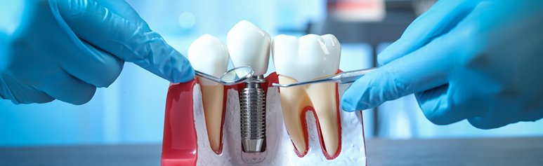 dental implants consultation mohali lumina dental best, dental implant vs denture